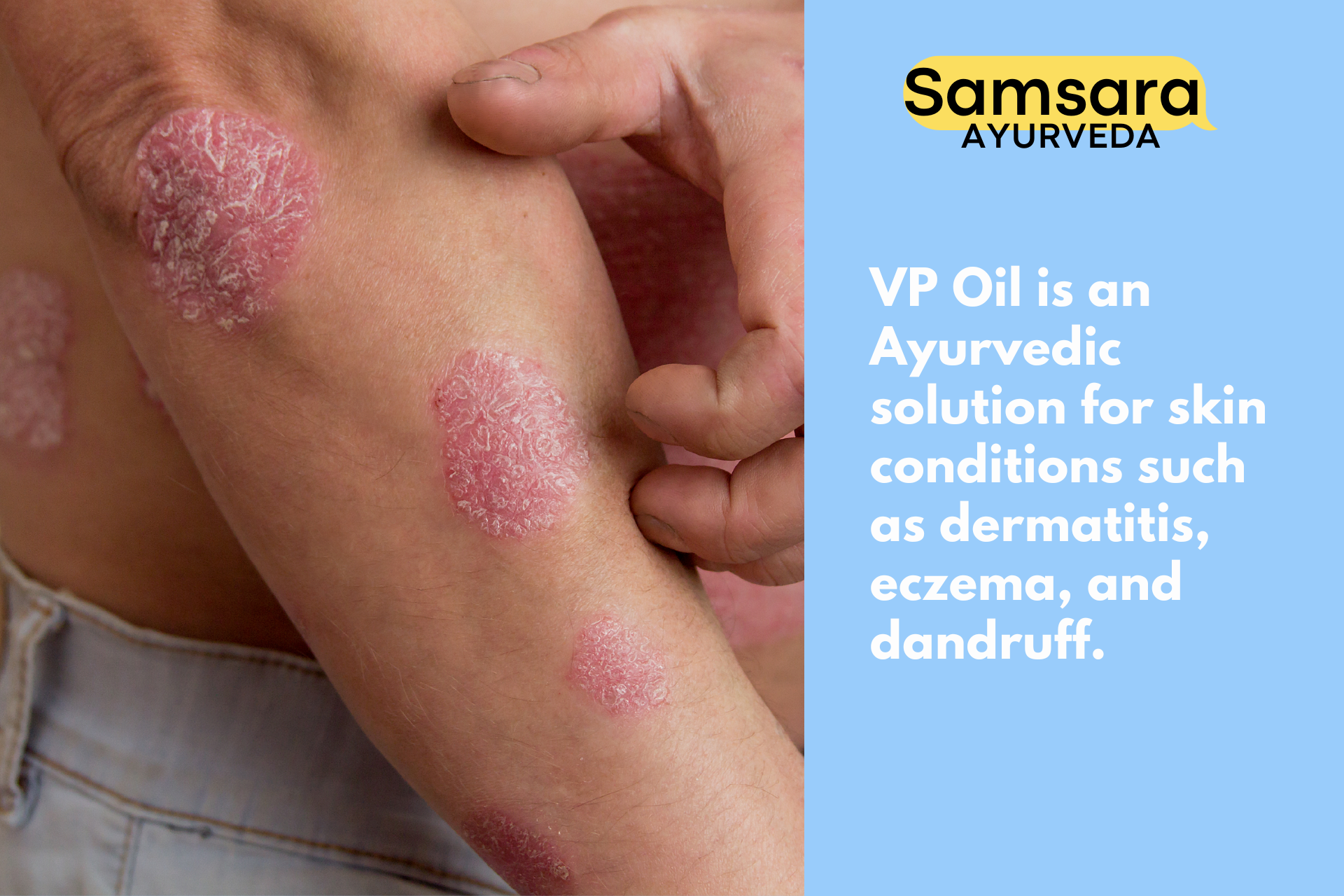 VP Oil - Vitpala Thaila Ayurvedic skin remedy